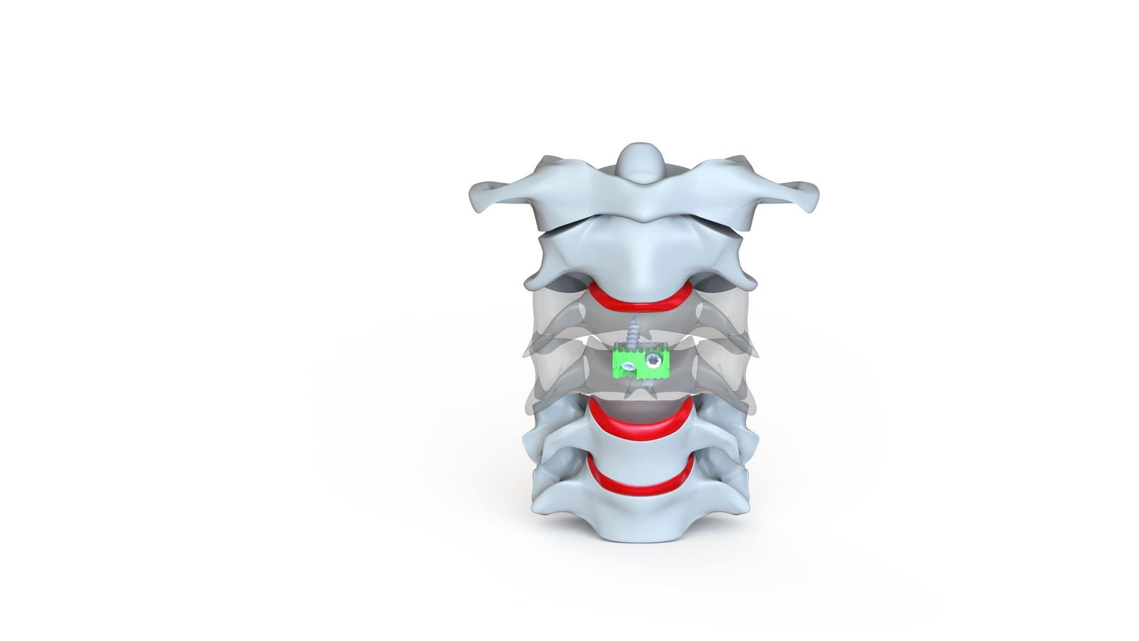 Cervical interbody fusion cage TITANOPEEK alternate view image 2