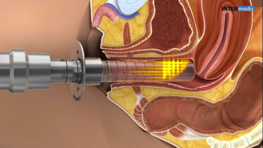 Gynecological surgery laser GYNELASE™ image 5