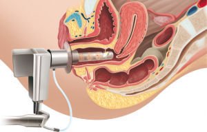 Gynecological surgery laser GYNELASE™ image 6