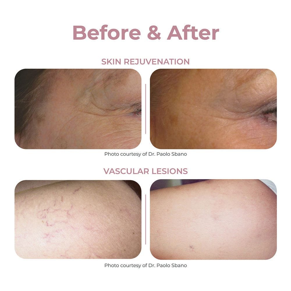 Hair removal laser Thunder Series image 6