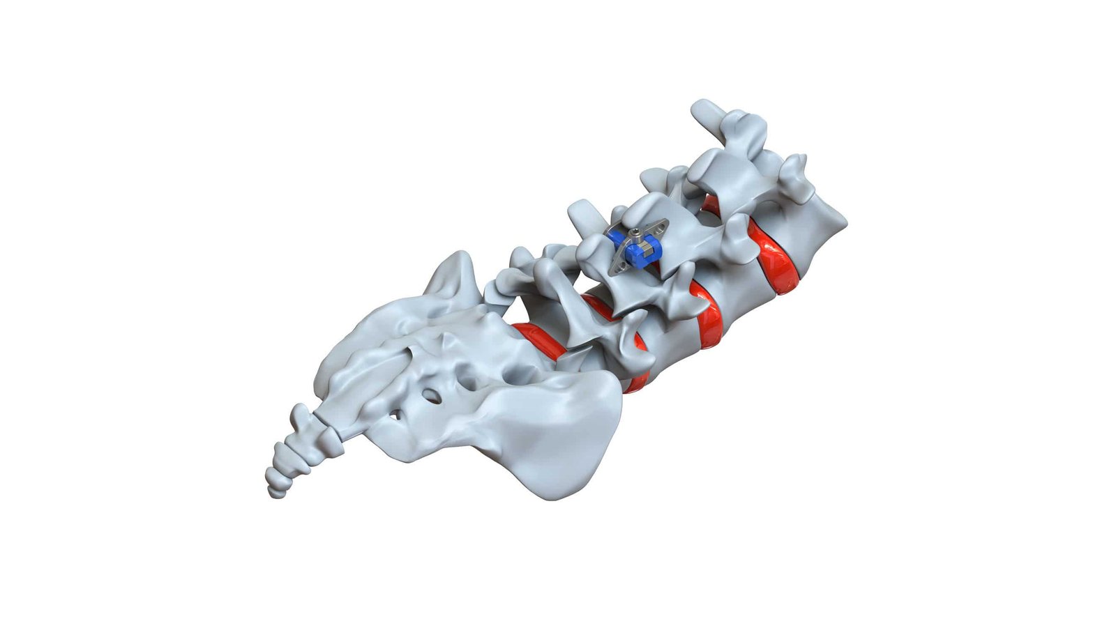 Lumbar interspinous vertebral implant STRATOS