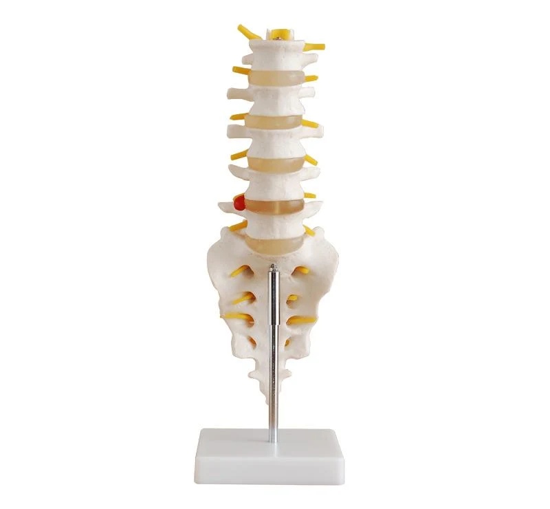 Lumbar Vertebrae with Sacrum & Coccyx and Herniated Disc Model