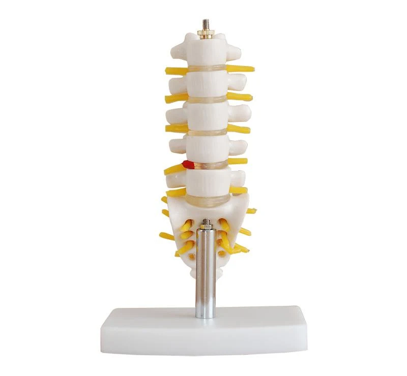 Mini Lumbar Vertebrae with Sacrum & Coccyx and Herniated Disc