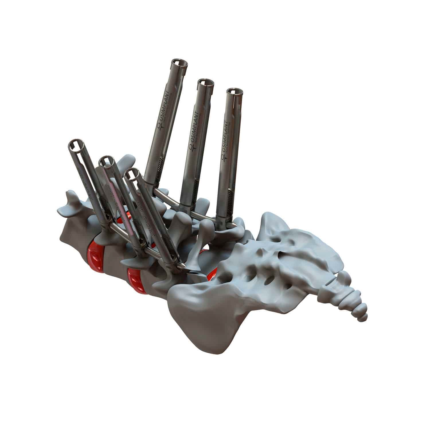 Minimally invasive pedicle screw positioning system ATHENA