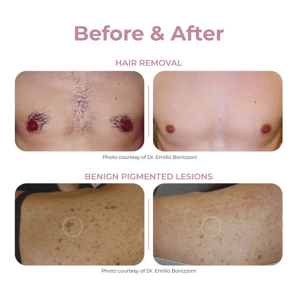 Pigmented lesion treatment laser Light series image 6