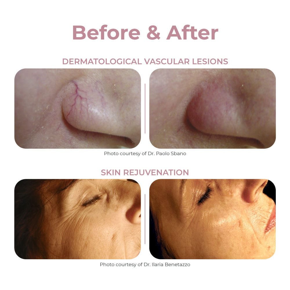 Pigmented lesion treatment laser Light series image 7