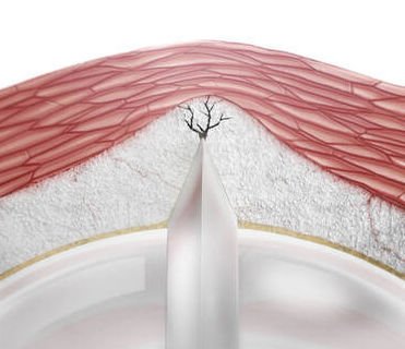 PTA catheter Aperta NSE PTA image 2