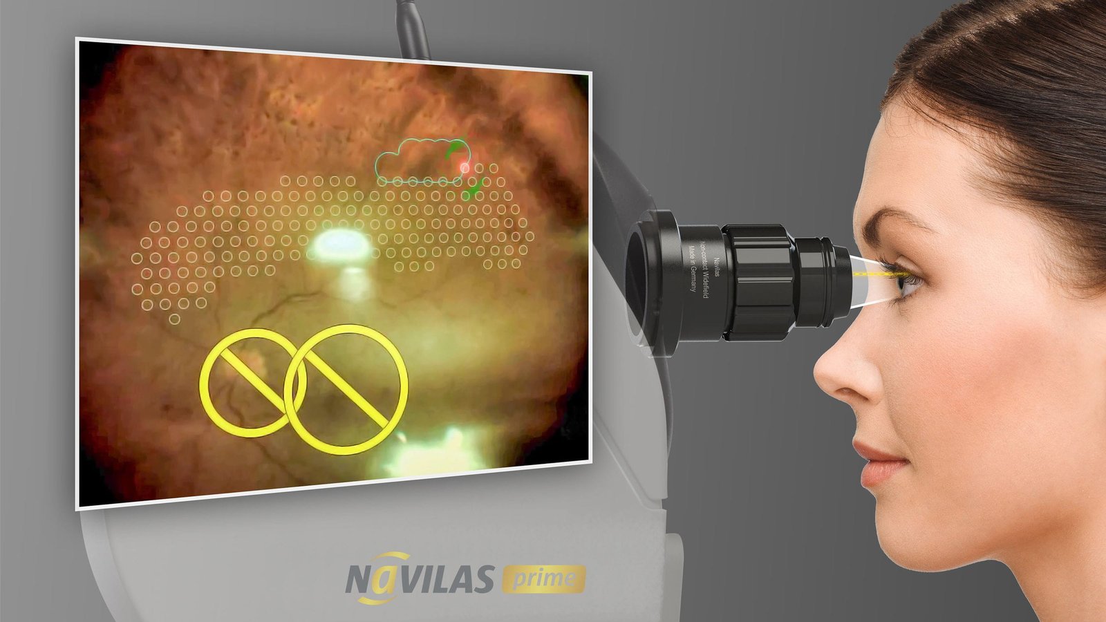 Retinal photocoagulation laser Navilas® 577s image 6
