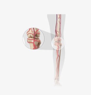 Support catheter Plutus™ image 3