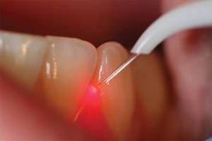 Surgery handpiece image 3