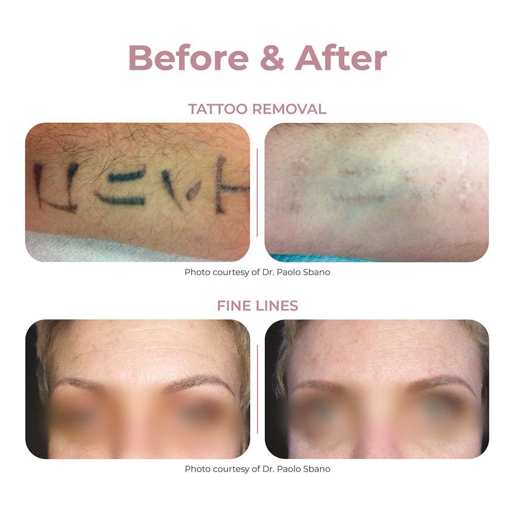 Tattoo removal laser Q-Plus C MT option image 5