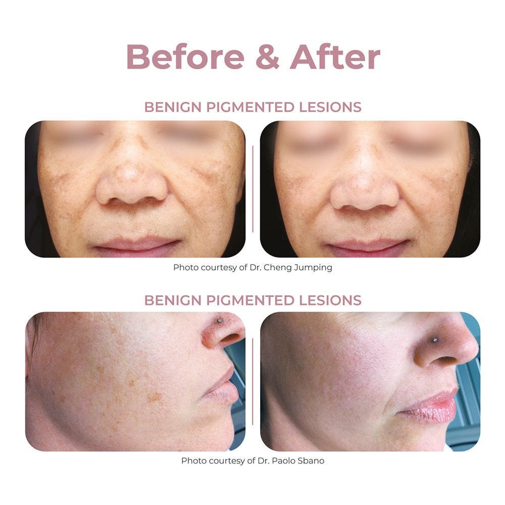 Tattoo removal laser Q-Plus C MT option image 6