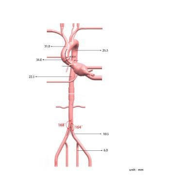 TAVR vascular model PLXZXG005 image 10