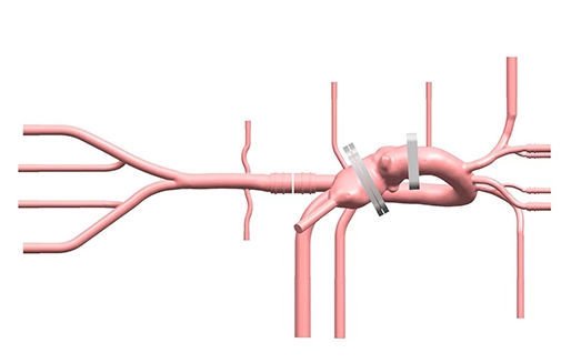 TAVR vascular model PLXZXG005 image 8